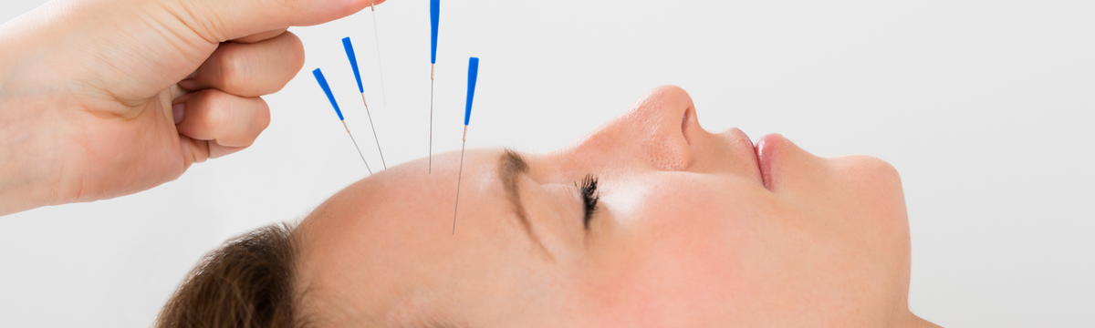 Acupuncture Treatment For Migraines