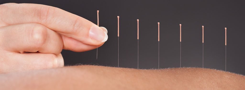 Acupuncture For Back Pain Orlando