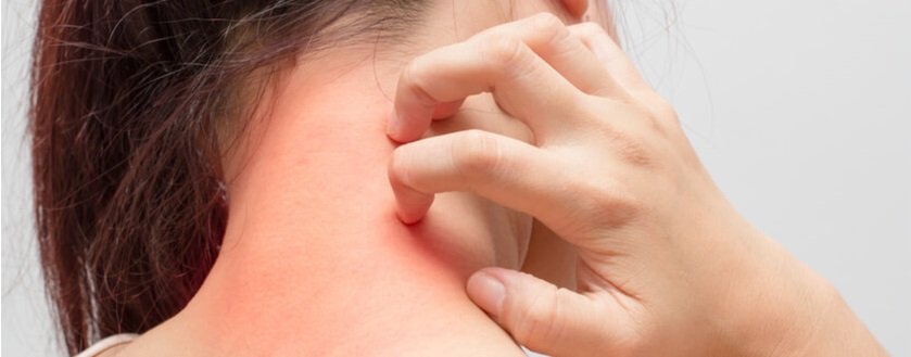 Acupuncture For Eczema In Orlando